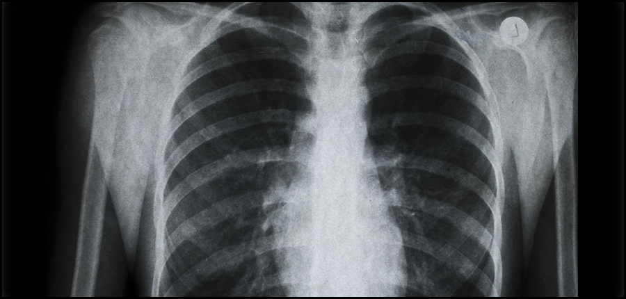 Stopper la progression du cancer agressif du poumon