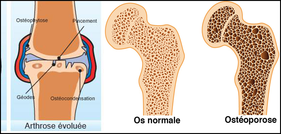 4ème Campagne Nationale de sensibilisation contre les maladies rhumatismales / 12 Octobre au 12 Novembre 2017