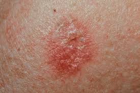 cancers de la peau 001