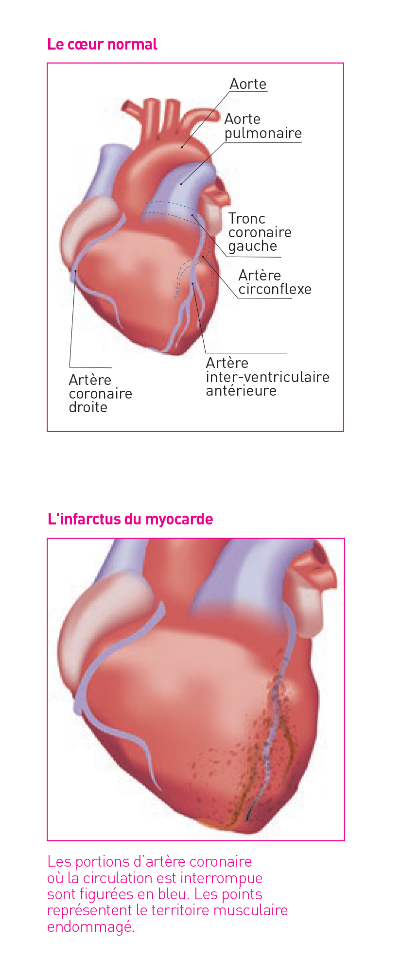 brochure laccident coronaire 8