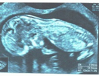 Retard de croissance intra uterin