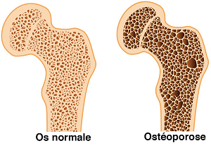 osteoporose 28022017